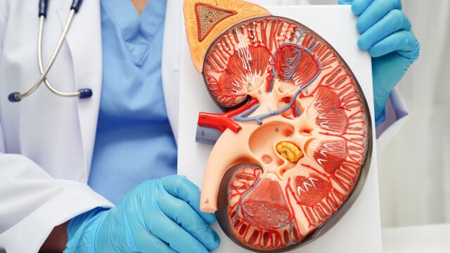 El cáncer de riñón es, tras el de próstata y vejiga, el tercer tumor urológico más frecuente