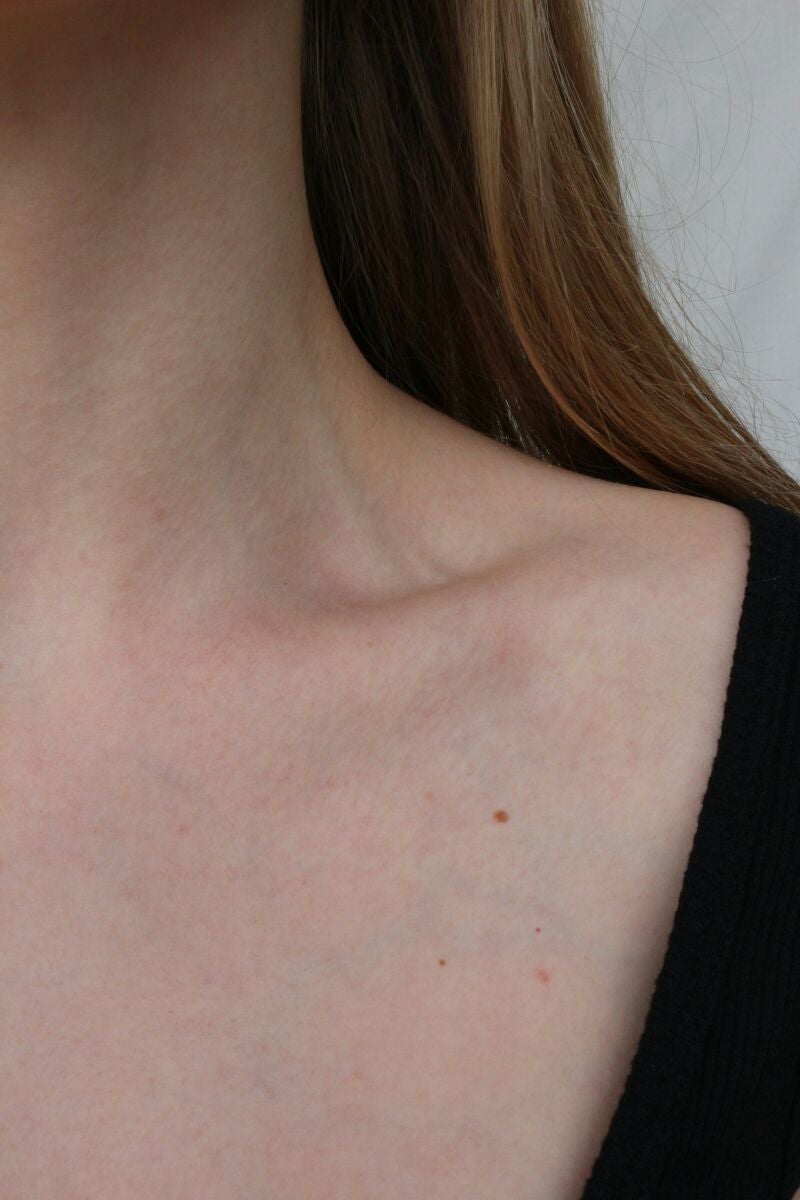 Tipos de verrugas comunes en cuello y axilas