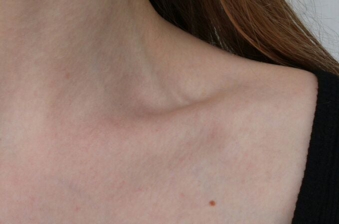 Tipos de verrugas comunes en cuello y axilas