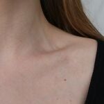 Tipos de verrugas comunes en cuello y axilas