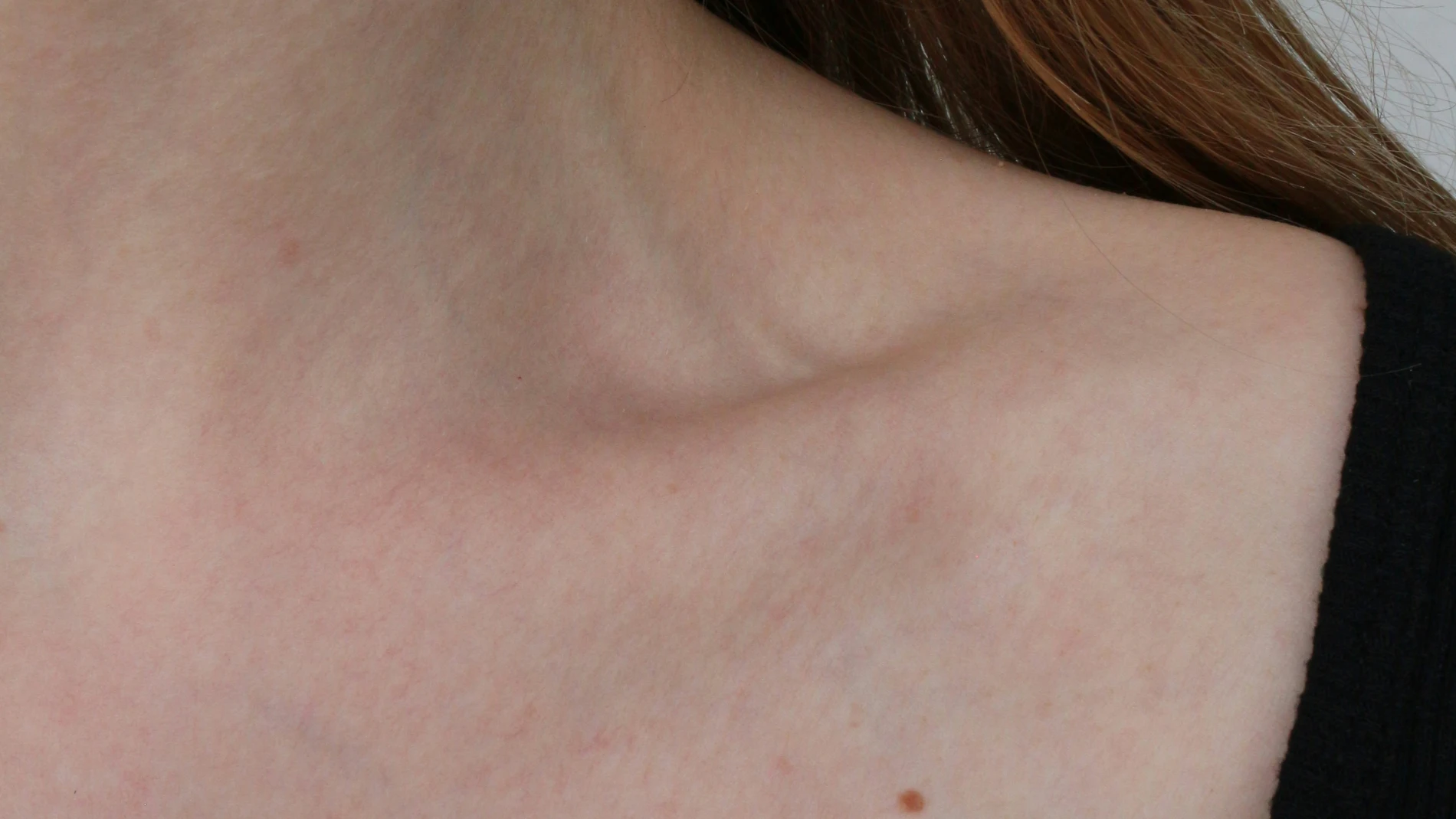 Tipos de verrugas comunes en cuello y axilas