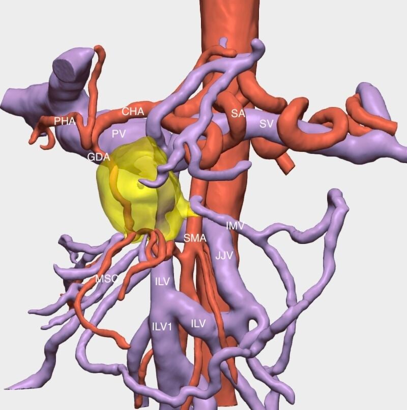 Reconstrucción del tumor en tres dimensiones