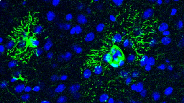 Descubren cómo una proteína provoca cambios tempranos en el cerebro que anticipan el alzhéimer 
