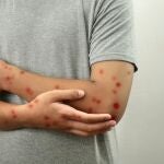Salud confirma cinco nuevos casos de sarampión en Almería, Granada y Málaga, un total de 77 en 2025
