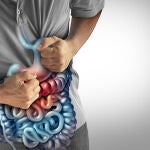 La colitis ulcerosa es una enfermedad inflamatoria intestinal crónica