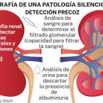 Enfermedad renal crónica