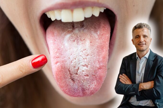 ¿Tienes marcas blancas en la lengua? Esto es lo que pueden estar indicándote según un experto