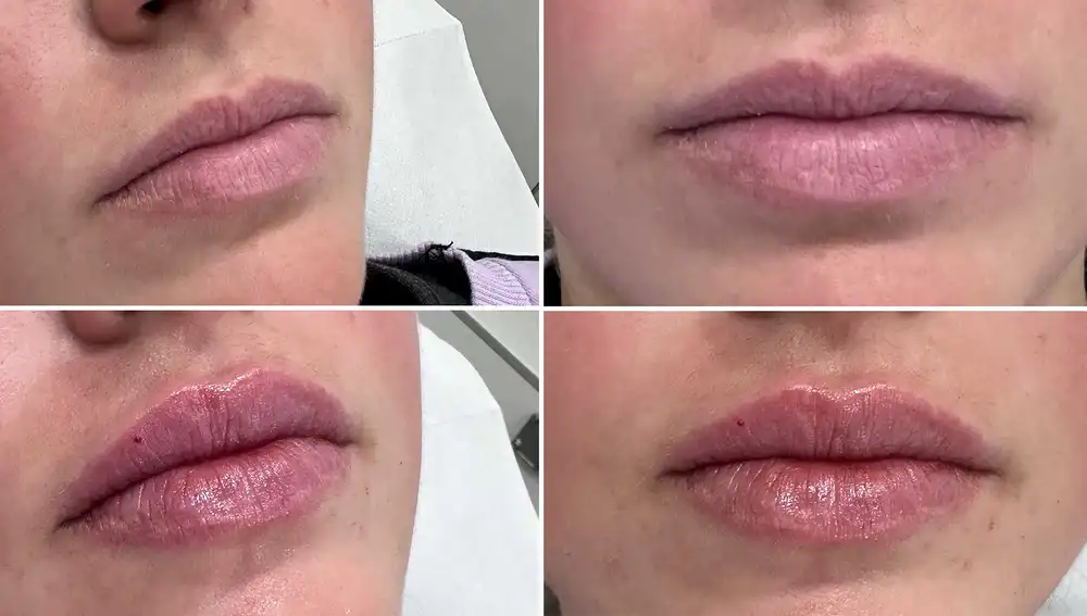 Tratamientorealizado con Tecnologia DUAL: acción de relleno inmediato para redefinir el contorno y volumen labial y bioestimulación progresiva que mejora la calidad del tejido desde dentro