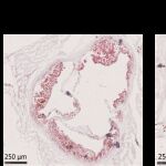  Imagen histológica de válvulas aórticas en un modelo murino de aterosclerosis. La tinción en rojo (Oil Red O) revela la acumulación de lípidos. A la izquierda, una válvula aortica de un ratón no tratado muestra una extensa lesión aterosclerótica. A la derecha, un ratón tratado con nanopartículas que contienen dexametasona y van dirigidas a cDC1s presenta una notable reducción de lípidos y menor desarrollo de la lesión. Estas nanopartículas permiten una modulación específica del sistema inmunitario, reduciendo la inflamación asociada a la progresión de la aterosclerosis.
