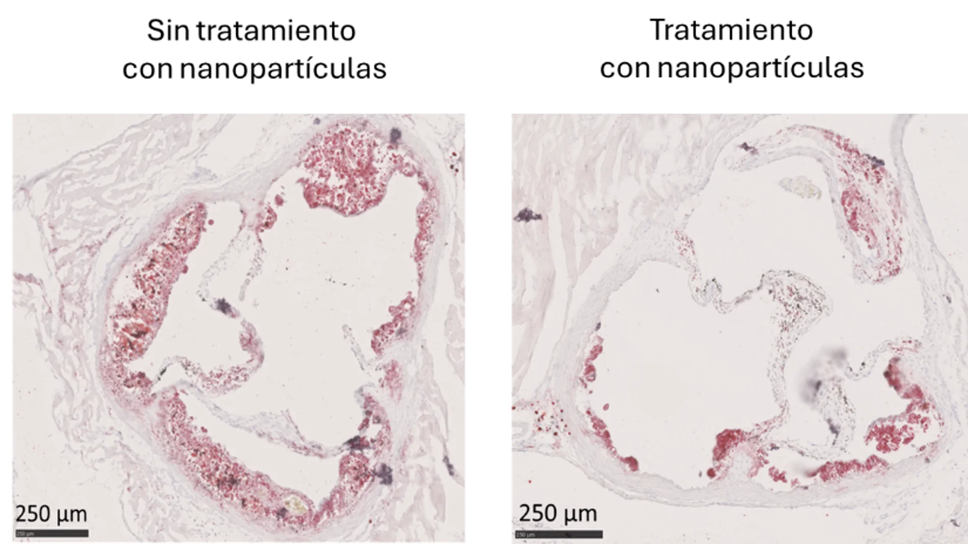 Imagen histológica de válvulas aórticas en un modelo murino de aterosclerosis. La tinción en rojo (Oil Red O) revela la acumulación de lípidos. A la izquierda, una válvula aortica de un ratón no tratado muestra una extensa lesión aterosclerótica. A la derecha, un ratón tratado con nanopartículas que contienen dexametasona y van dirigidas a cDC1s presenta una notable reducción de lípidos y menor desarrollo de la lesión. Estas nanopartículas permiten una modulación específica del sistema inmunitario, reduciendo la inflamación asociada a la progresión de la aterosclerosis.