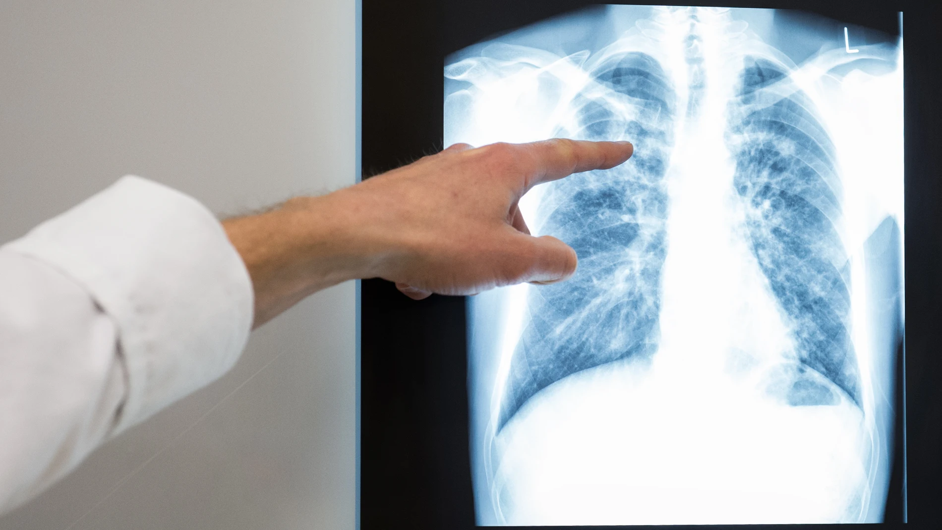 (Foto de ARCHIVO) FILED - 02 March 2017, Berlin: A doctor points to a lung X-ray at Vivantes Neukoelln Hospital. Hepatitis, HIV, tuberculosis (TB) and sexually transmitted infections such as syphilis and gonorrhoea continue to pose significant challenges for health systems in Europe, the European Centre for Disease Prevention and Control (ECDC) concluded. Photo: Silas Stein/dpa 02/03/2017 ONLY FOR USE IN SPAIN