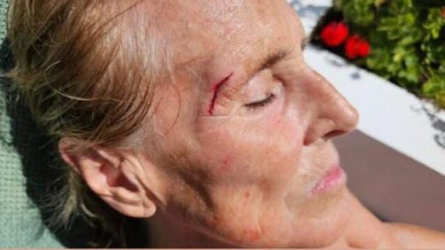 Mercedes Milá sufre un accidente doméstico y así ha quedado su cara