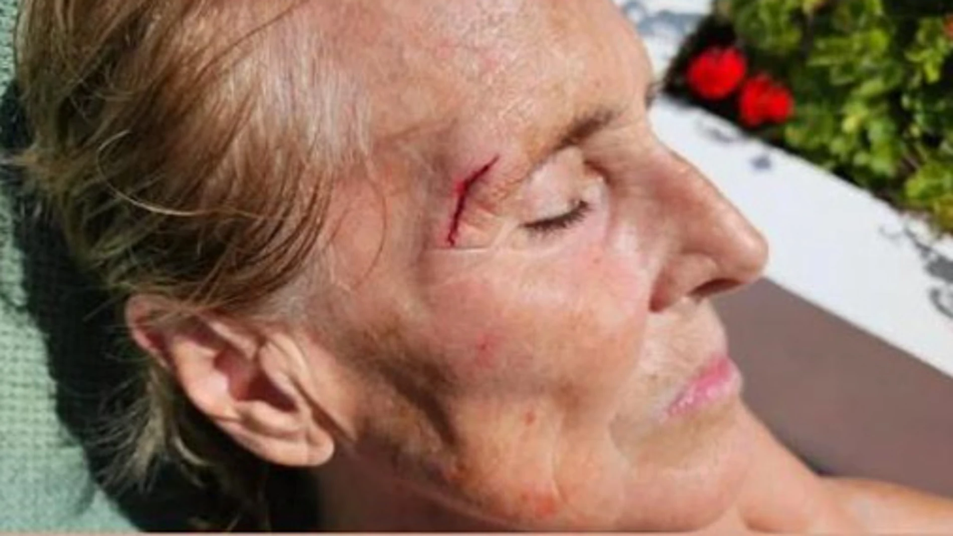 Mercedes Milá sufre un accidente doméstico y así ha quedado su cara