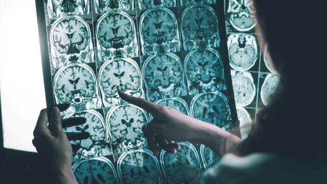 Los ensayos clínicos han demostrado los beneficios de las nuevas terapias contra esta demencia avanzada