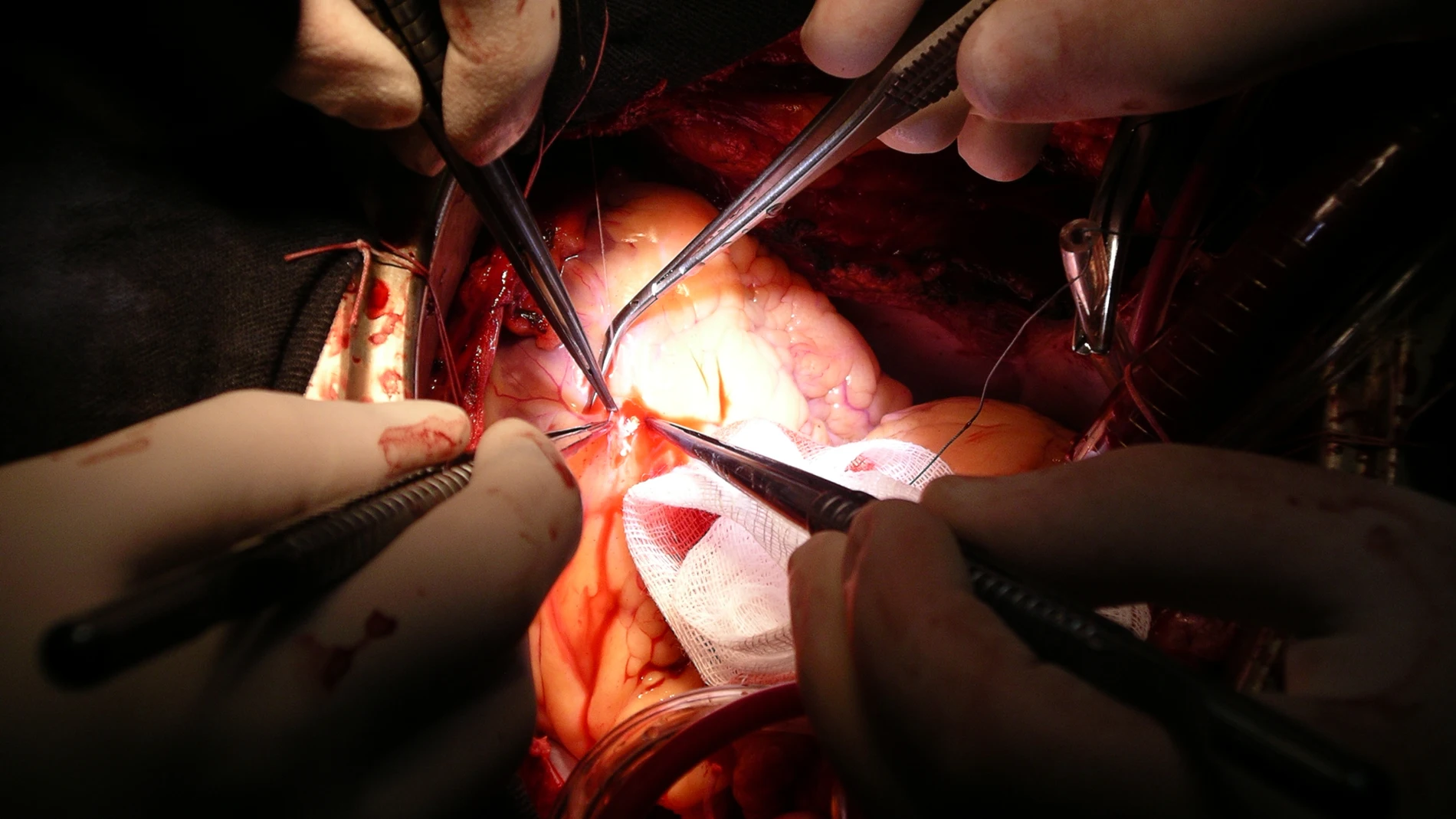 El 50% de los trasplantes cardiacos que se realizan en España son de carácter urgente