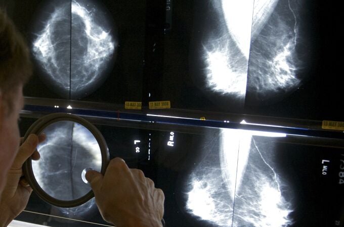 El cribado de este tumor es fundamental