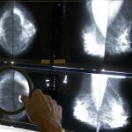 El cribado de este tumor es fundamental
