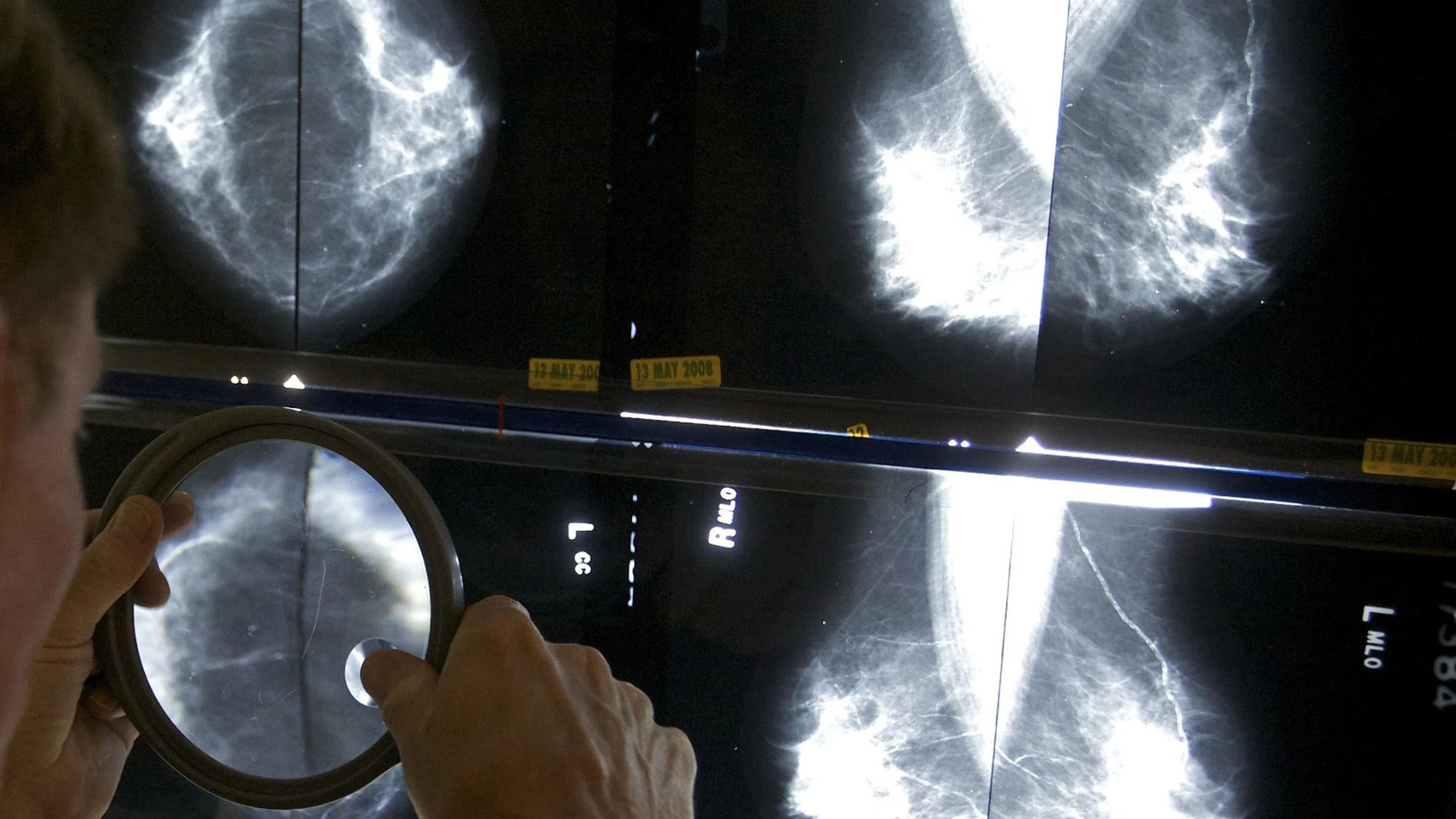 El cribado de este tumor es fundamental