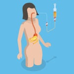 También se le llama dieta enteral o de la sonda