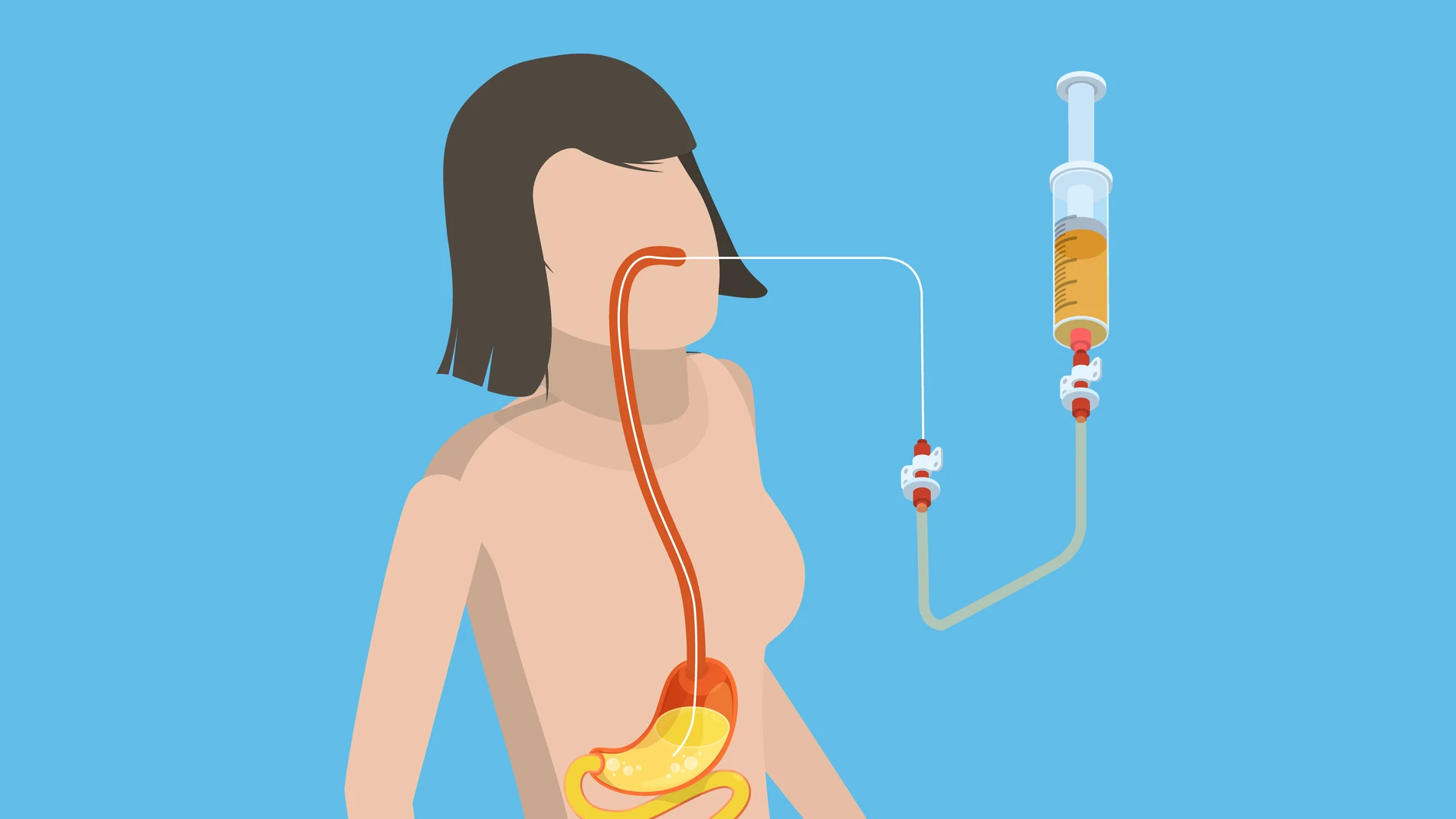 También se le llama dieta enteral o de la sonda