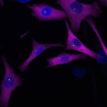 Descubren un "sistema GPS" del melanoma que podría frenar la metástasis