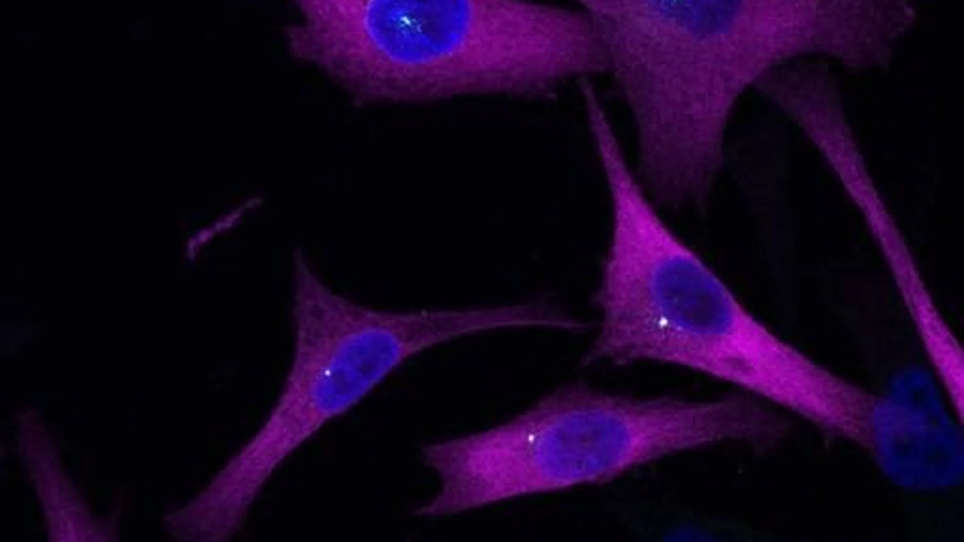 Descubren un "sistema GPS" del melanoma que podría frenar la metástasis