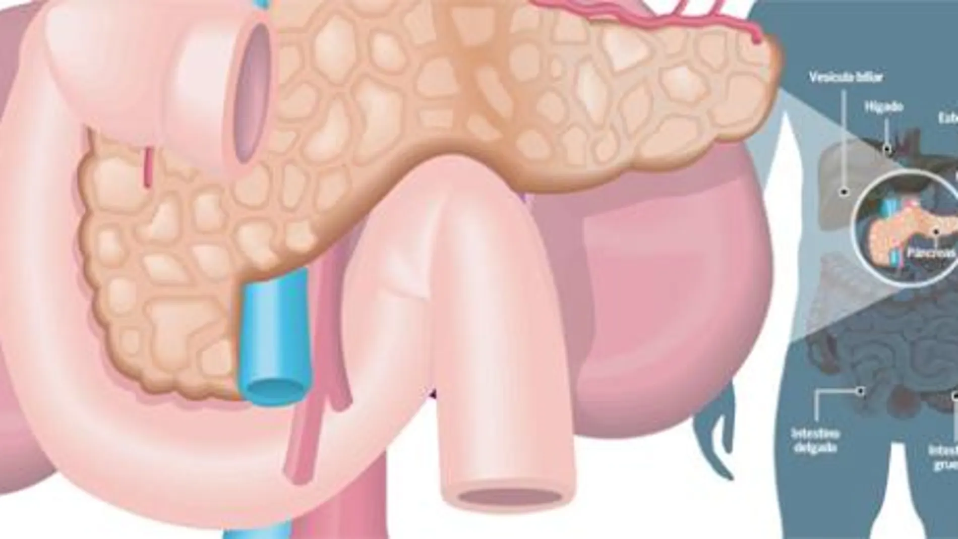 Diabetes: la «dulce» Navidad, el enemigo del paciente