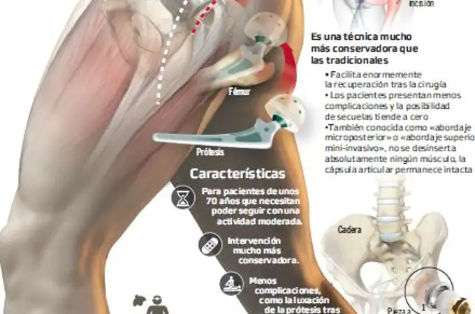 Europa implantará 1,7 millones de prótesis de cadera el próximo año