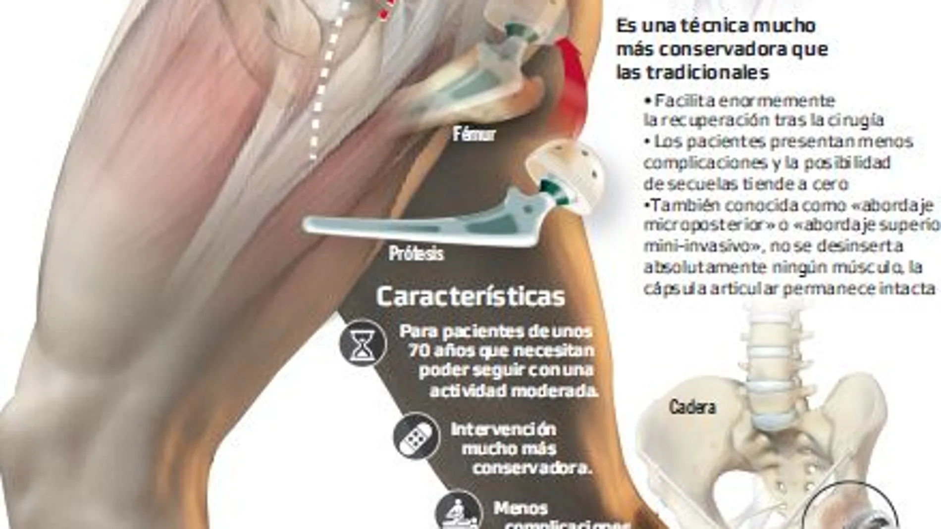 Una nueva técnica coloca prótesis de cadera con mínima incisión