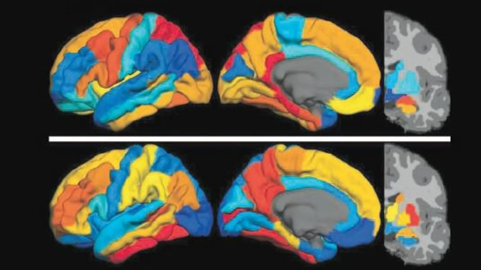 La actividad de Tau en los diez voluntarios que padecían alzhéimer era especialmente diferente en los lóbulos temporales y en la corteza cerebral