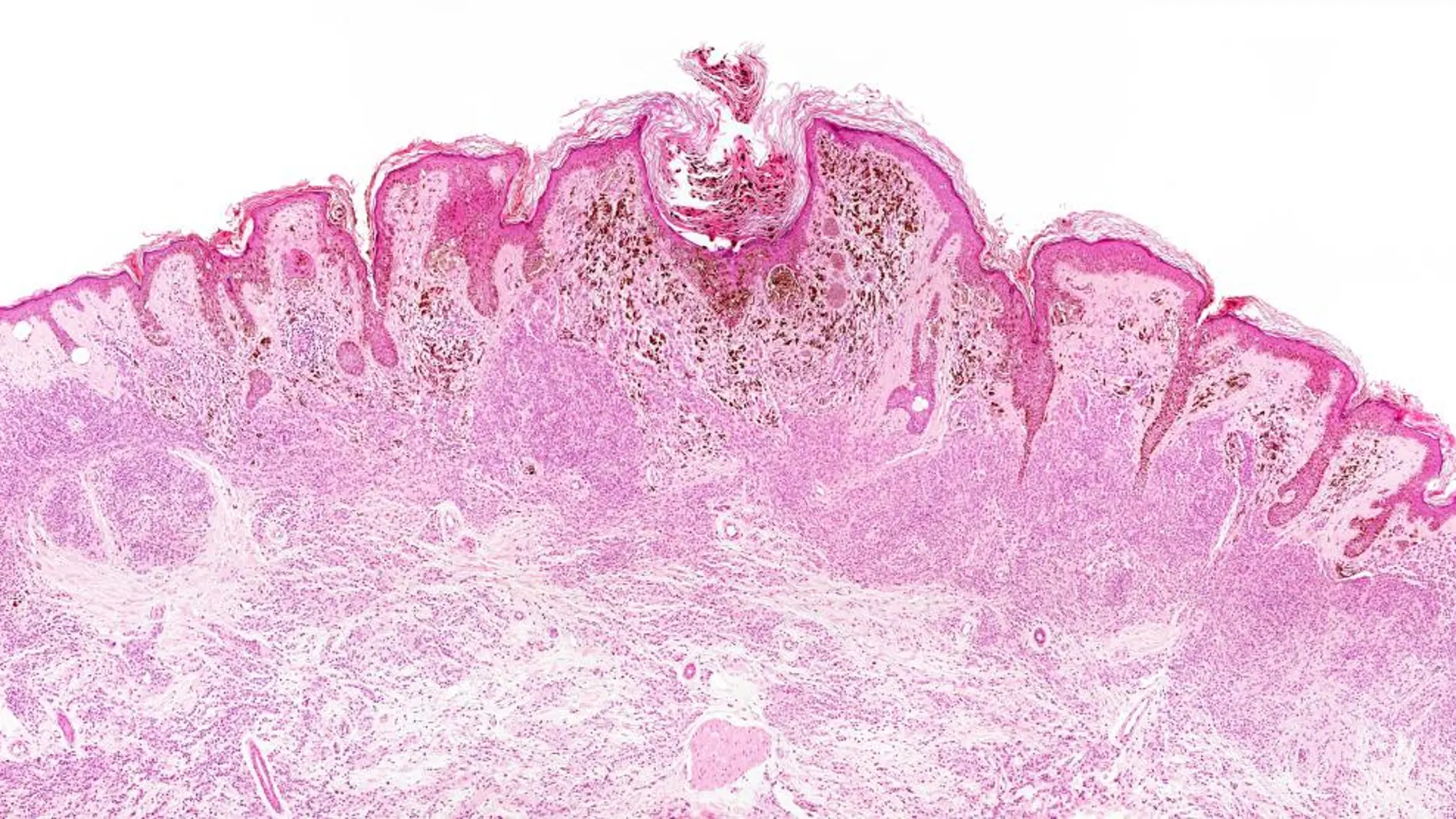 Un melanoma visto al microscopio