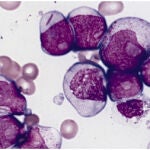 Células de leucemia