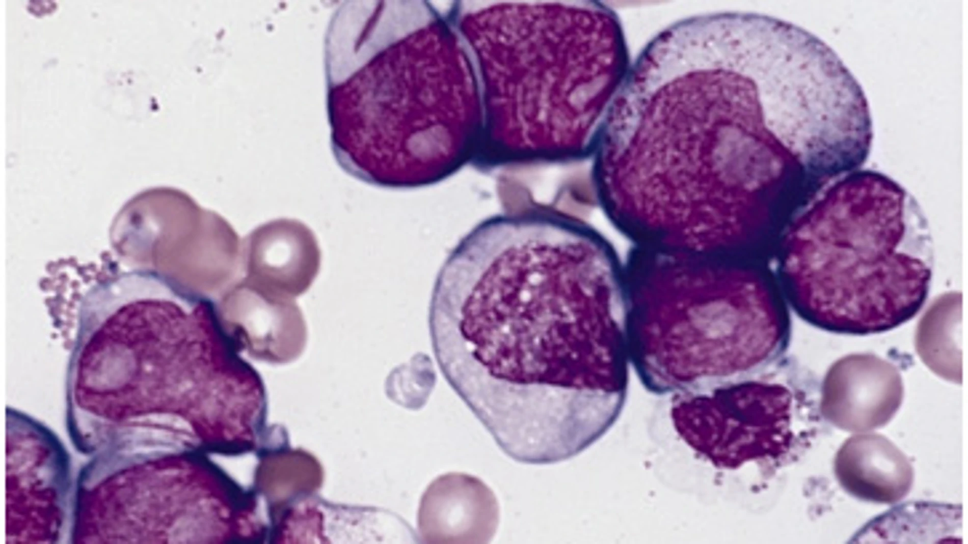 Células de leucemia