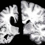 En la imagen de la izda., un cerebro con alzhéimer. A la dcha., el cerebro sin enfermedad
