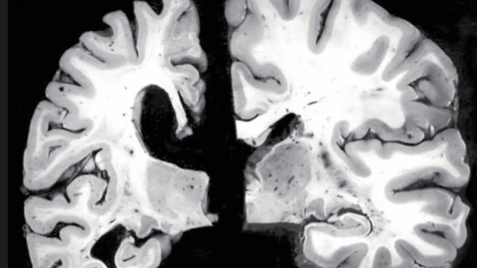 En la imagen de la izda., un cerebro con alzhéimer. A la dcha., el cerebro sin enfermedad