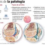 Aterriza en España el fármaco más eficaz contra la artritis psoriásica