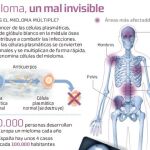 Nuevas moléculas para sumar vida frente al mieloma múltiple