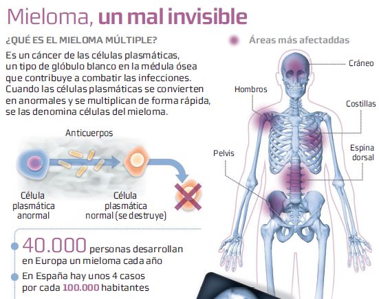 mieloma múltiplo de células plasmáticas