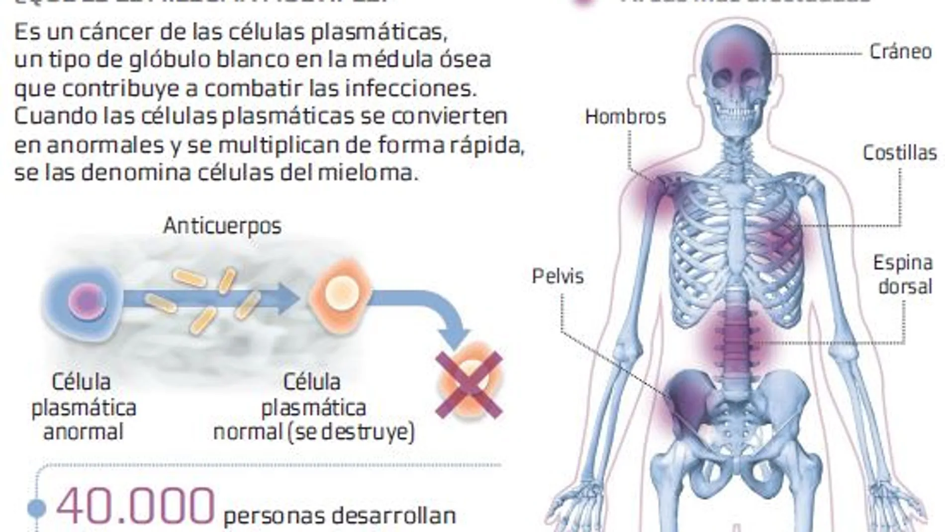 Nuevas moléculas para sumar vida frente al mieloma múltiple
