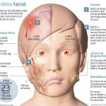 La rehabilitación recupera la función facial tras una parálisis