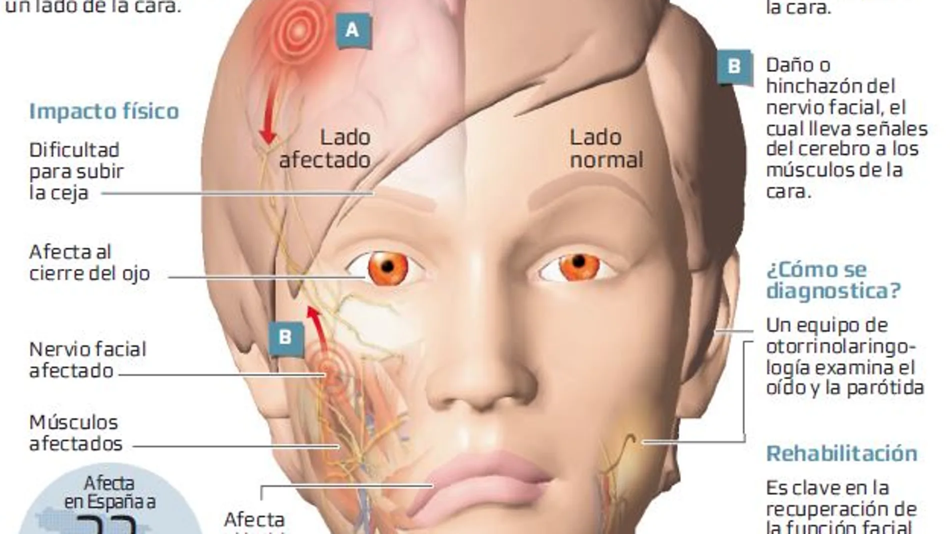 La rehabilitación recupera la función facial tras una parálisis