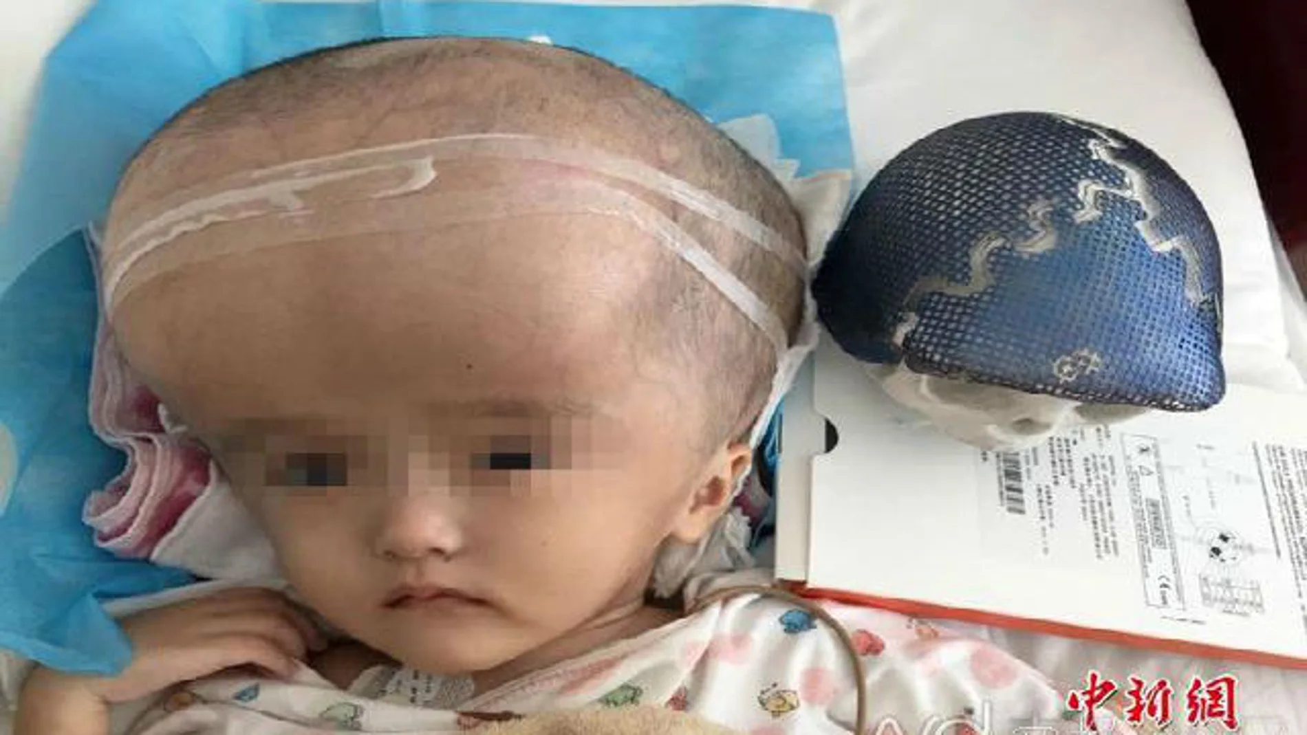 El cráneo de la niña había crecido cuatro veces más de lo normal y los médicos tuvieron que drenar 15 litros de líquido