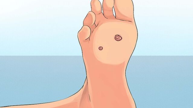 Papilomas en los pies. Todos los niños deberían llevar escarpines en las piscinas públicas.