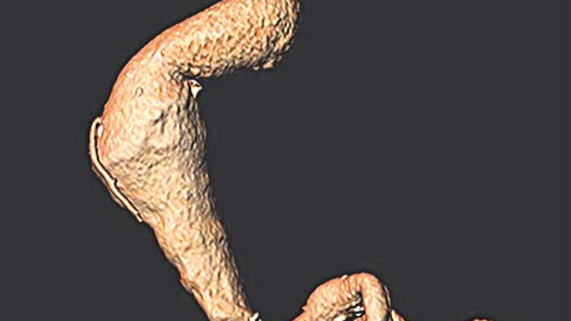 Imagen de la aneurisma