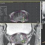 La fusión de las imágenes de resonancia magnética postprocesadas y ecografía para ofrecer a los especialistas una imagen clara del tumor que necesitan analizar mediante biopsia para determinar si un paciente sufre cáncer de próstata o no