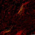 Detección de óxido nítrico (en rojo) cerca de los vasos sanguíneos (detectados mediante microangiografía; en verde) que irrigan un tumor, tras aumentar los niveles de SOD3. El amarillo indica la superposición de los dos colores