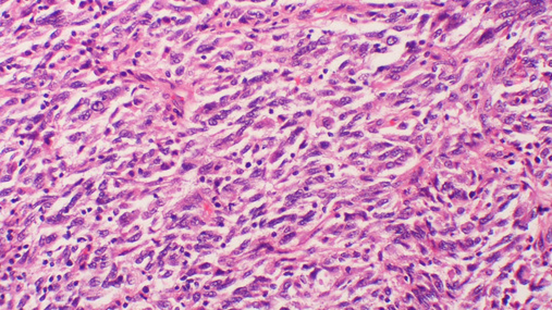 Muestra celular de melanoma con metástasis