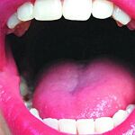En verano se eleva el número de bacterias en la boca