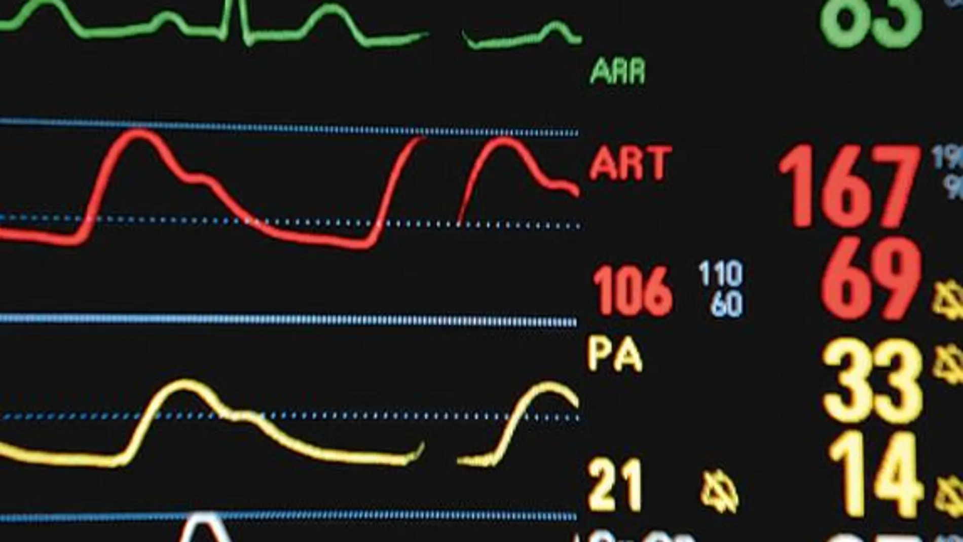 Los latidos cardíacos irregulares aumentan el riesgo de Covid-19 grave