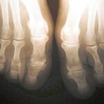 Un antiinflamatorio reduce hasta cuatro veces el riesgo de daño en el estómago